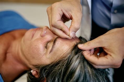 Hilft Akupunktur bei Kopfschmerzen?