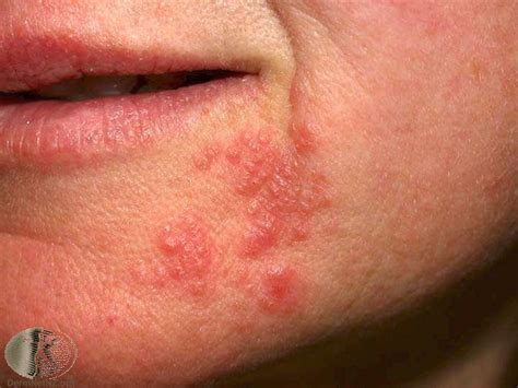 Perioral Dermatits | Ailesbury Clinic
