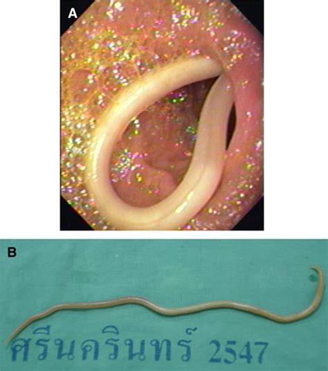 Biliary Ascariasis After Worm Removal from the Duodenum and Single-Dose ...