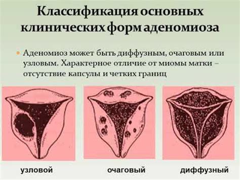 ЭНДОМЕТРИОЗ. - YouTube