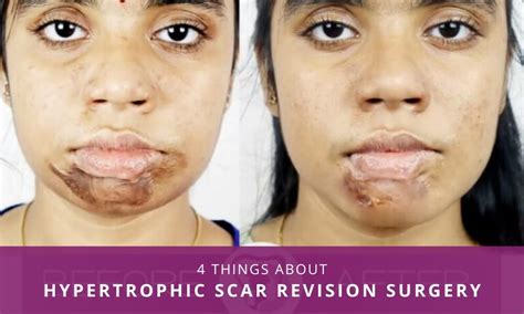 What Are Hypertrophic Scars at Carlos Snyder blog