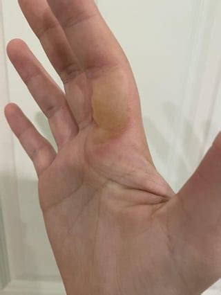 progress of my second degree burn blisters. : r/MedicalGore