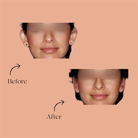 otoplasty earlobe reduction expert ear reshaping  size reduction