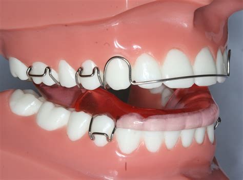 overbite correction  retainers