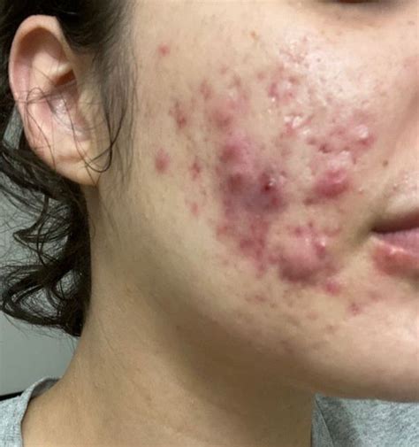 nodular cystic acne