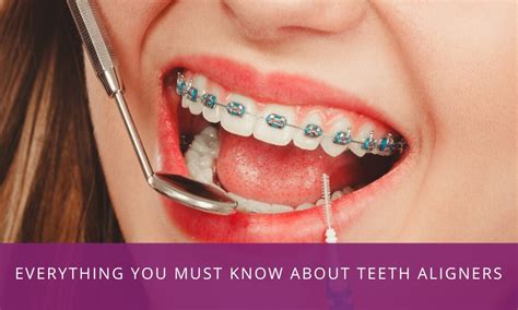 teeth aligners richardsons plastic