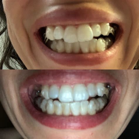 aligners    overbite  katie felton blog