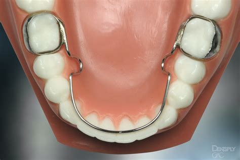 dental code  fixed lingual retainer  david bingham blog