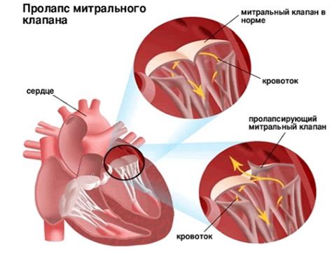 Пролапс митрального клапана симптомы