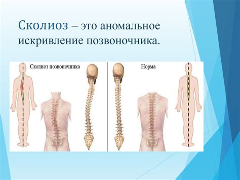 Сколиоз. Причины возникновения сколиоза. Виды сколиоза - презентация онлайн