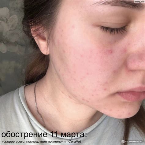 Препарат для лечения акне Метрогил А - «Метрогил А при демодекозе» | отзывы