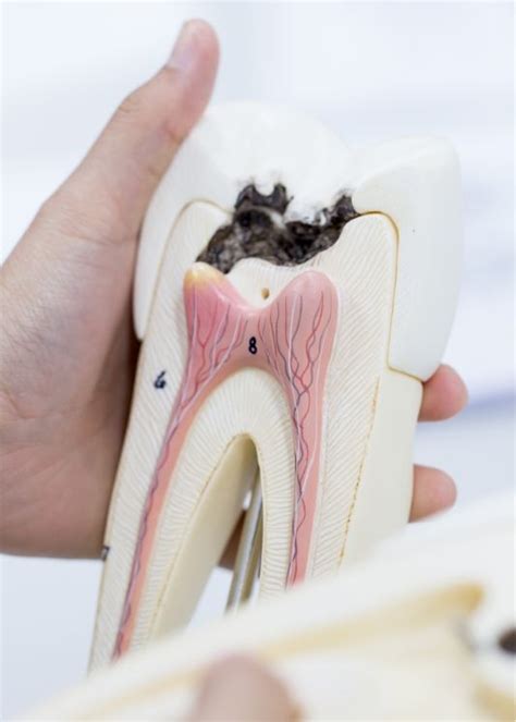 Pulp (Nerve) Treatments Katy, TX | Pediatric Emergency Dentist | Wellspring Pediatric Dentistry