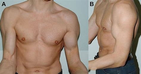 Bicep Tendon Rupture | OrthoSD.com