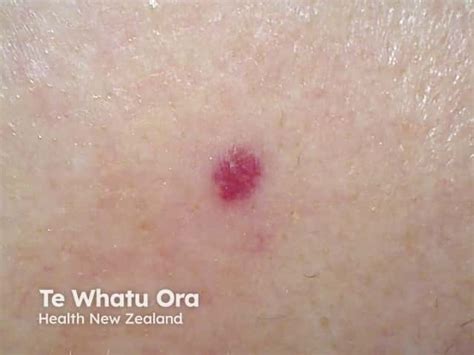 Cherry Hemangioma