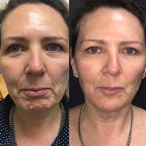 Non Surgical Face Lift With Fillers at Jake Congreve blog