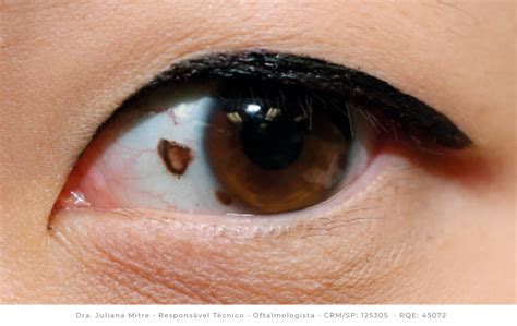 Melanoma ocular: o que é e como tratar? – Grupo HOSP
