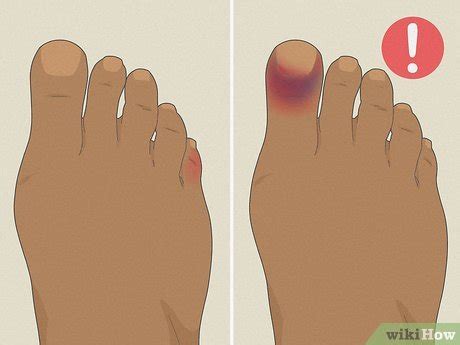 how to heal a broken toe at home