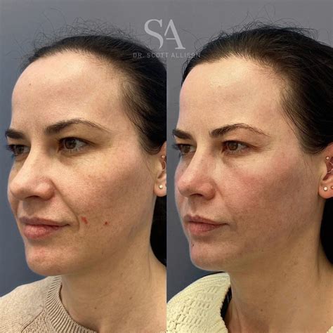 CO2 Laser Brisbane — Enhanced Skin After 6 Months