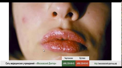 Аллергия на губах - YouTube