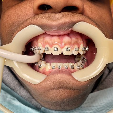 Stained Teeth After Braces