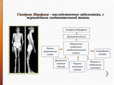 Синдром Марфана - презентация онлайн