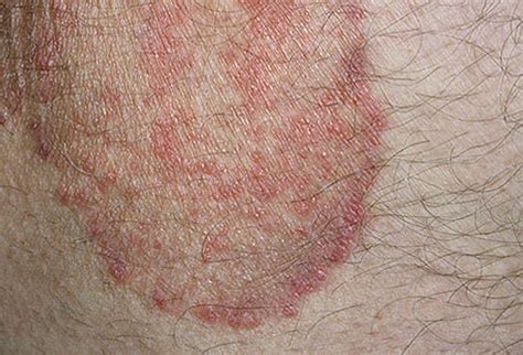 Is Jock Itch Contagious? | New Health Advisor