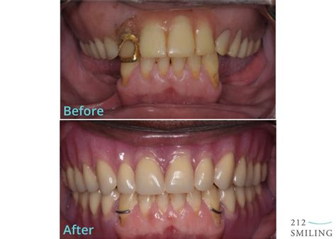 Before And After Partial Dentures