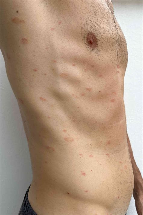 stages  pityriasis rosea pictures