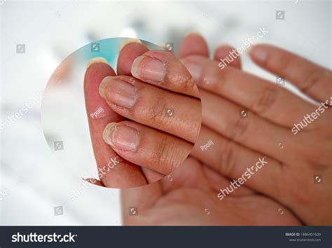 26,336 Cracked nail Images, Stock Photos & Vectors | Shutterstock