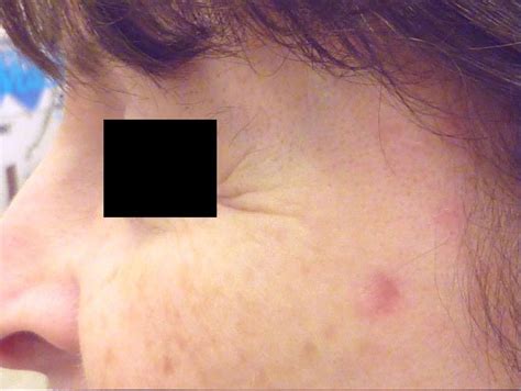 excision fairfield dermatology