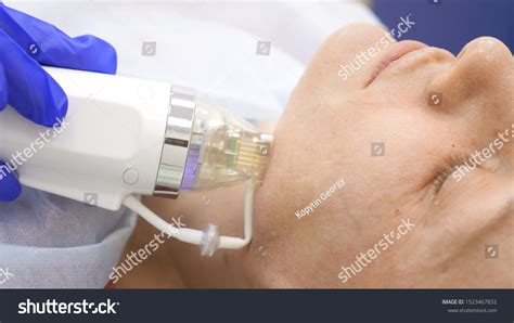 56 Face Microneedling Rf Images, Stock Photos & Vectors | Shutterstock