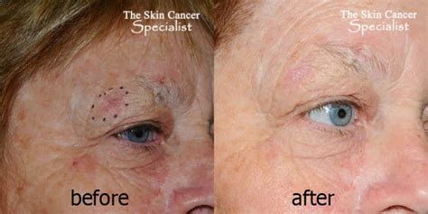 Laser Skin Cancer Therapy Treatment Surgery - Dr Peter Kim