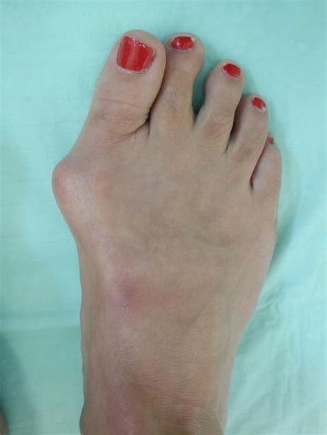 Bunion Symptoms | Sole Remedy Foot Care