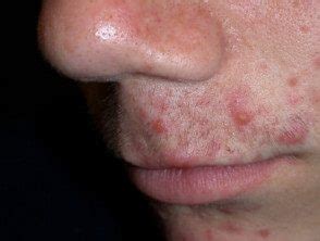 Imágenes faciales del acné - Hoogstra - Centros Medicos