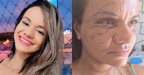 Como Ficou O Rosto Da Mulher Que Levou 60 Socos - Mulher agredida com 60 socos mostra rosto uma semana após cirurgia