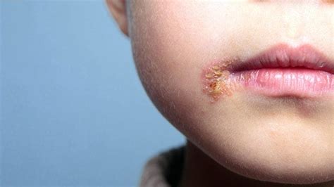 impetigo  es sintomas transmision  tratamiento