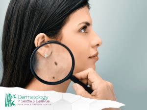 how much does it cost to get moles checked