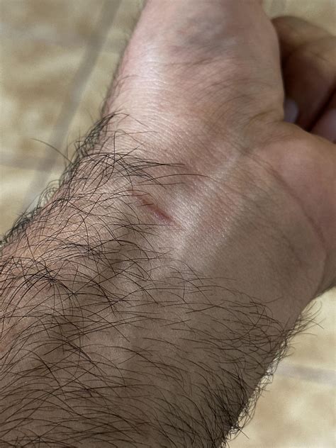 i have 8 keloids , is this 9 ? : r/Keloids