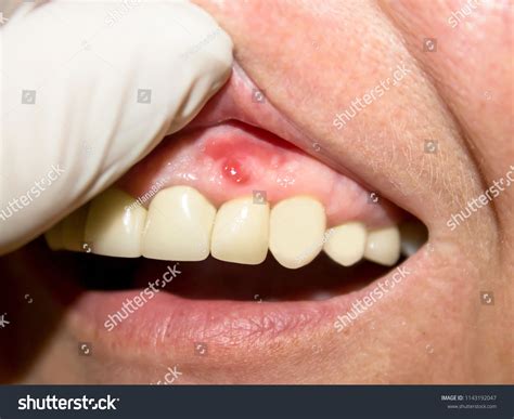 10,992 Oral Infection Images, Stock Photos & Vectors | Shutterstock