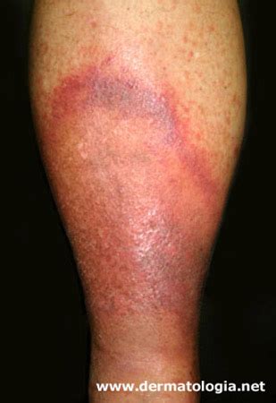 O Que É Erisipela Na Perna - Erisipela - Dermatologia.netDermatologia.net