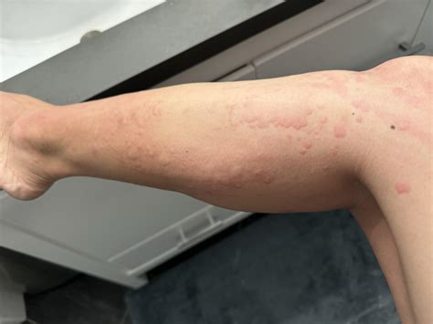 Body Allergic Reaction Researchers Identified A New Pathological