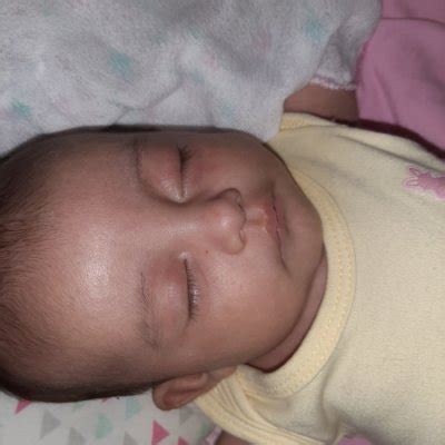 Mancha Vermelha Na Palpebra Do Bebe - Bebê com a pálpebra vermelha | BabyCenter