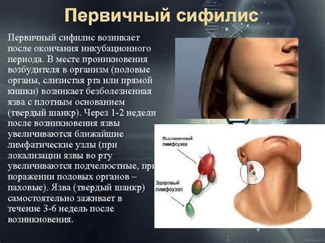 Презентация на тему СИФИЛИС СИМПТОМЫ СИФИЛИСА ЛЕЧЕНИЕ СИФИЛИСА