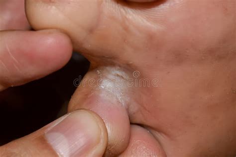 closeup  tinea pedis infection  toes showing scaling skin