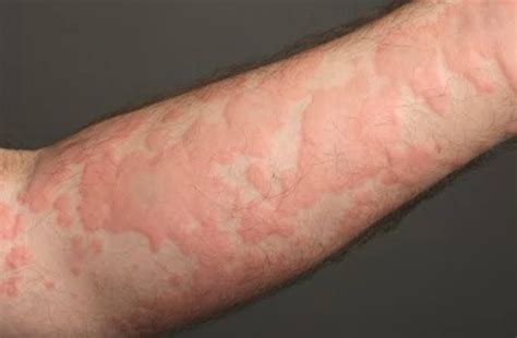 O Que Pode Causar Urticária - O que é Urticária? | Dermatolaser