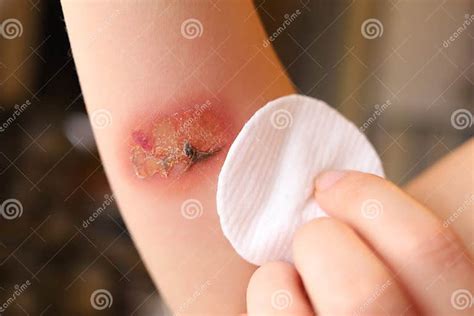 Burn on the Hand, Treatment, First Aid, Application of Medicine Stock Photo - Image of flesh ...