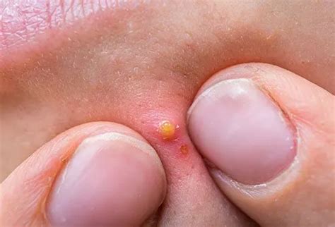 What Causes Boils on Private Areas? Home Remedies, Treatment