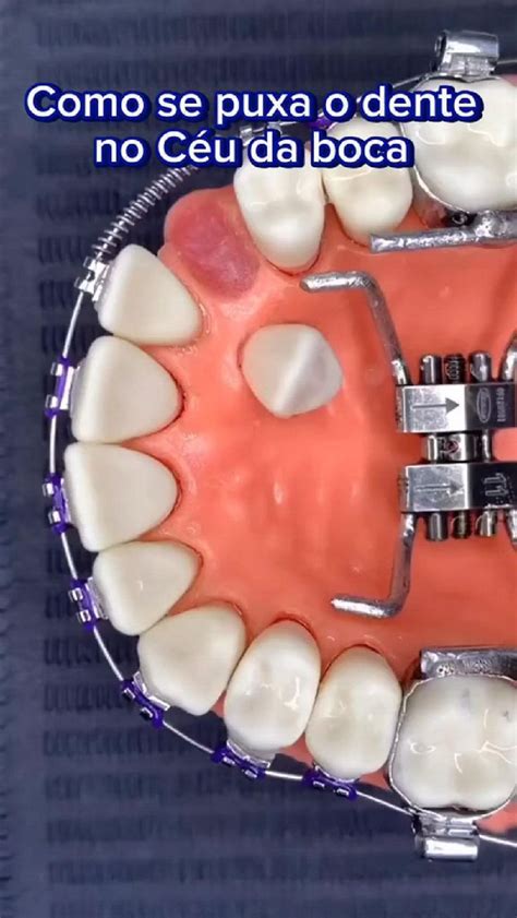 Dente No Céu Da Boca É Perigoso - Puxando um dente no céu da boca