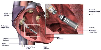 The Medtronic Micra Leadless Pacemaker | Dr Oliver Segal