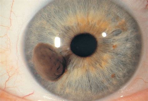 Iris Abnormalities